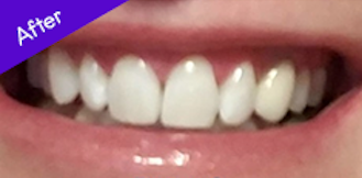 Best teeth whitening for thin enamel